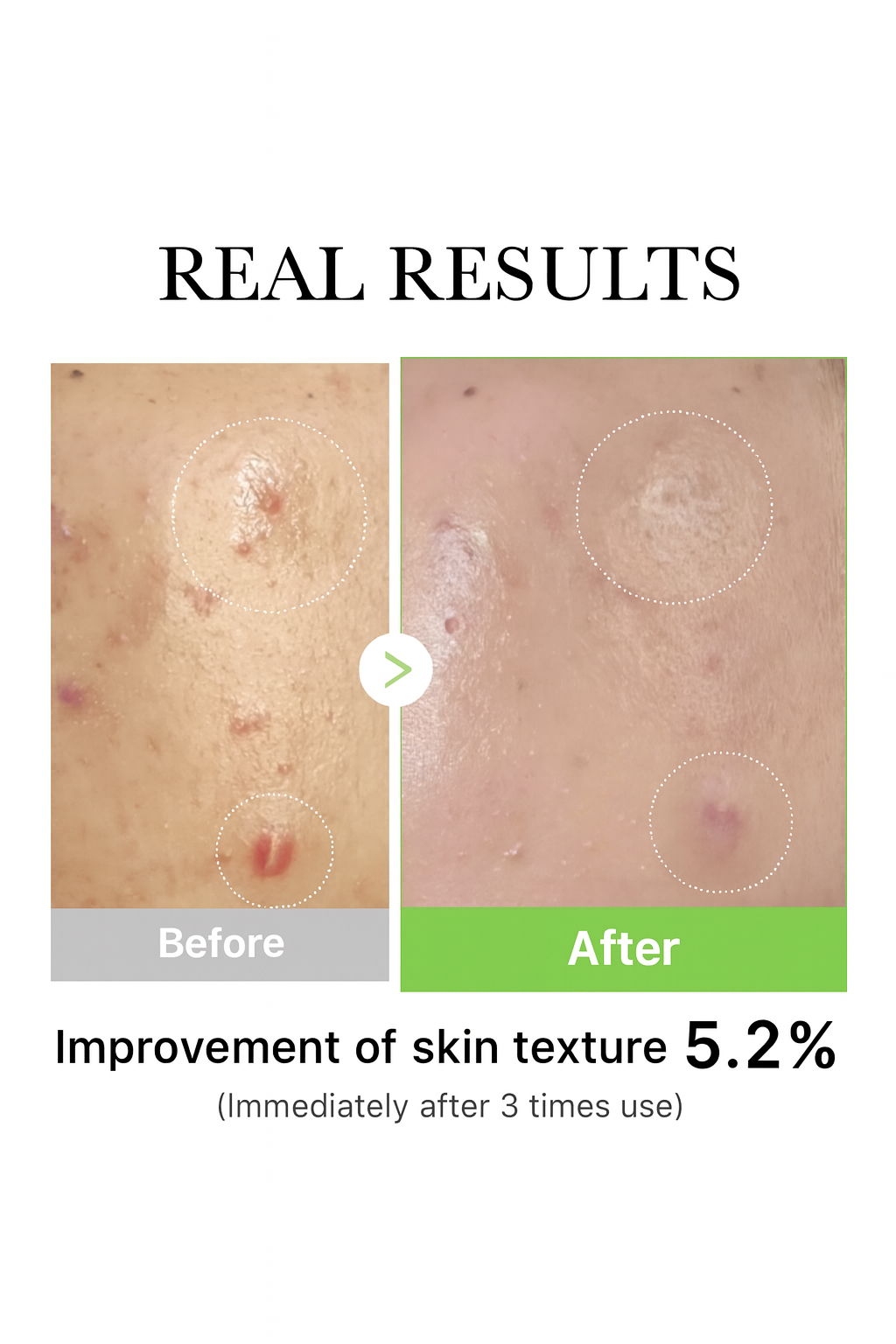 Pureve EPICLEAR MD Tea Tree Serum