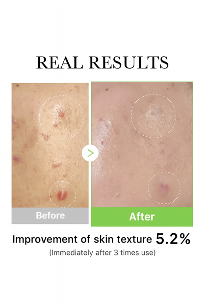 Pureve EPICLEAR MD Tea Tree Serum